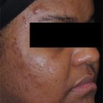 AviClear Before & After Patient #1671